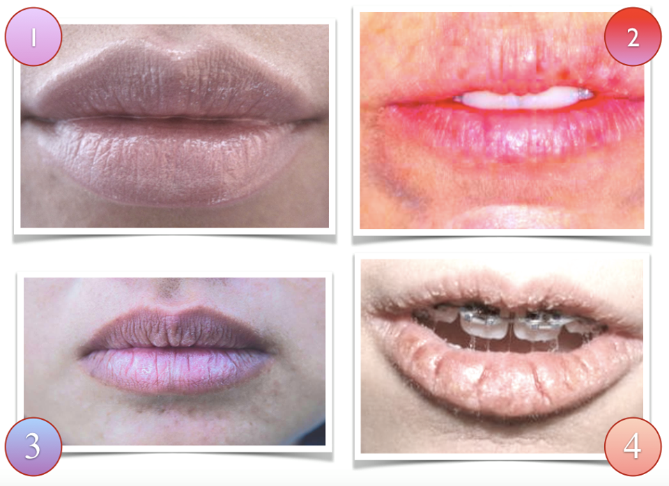 Tcm Diagnosis Lips Observation. 