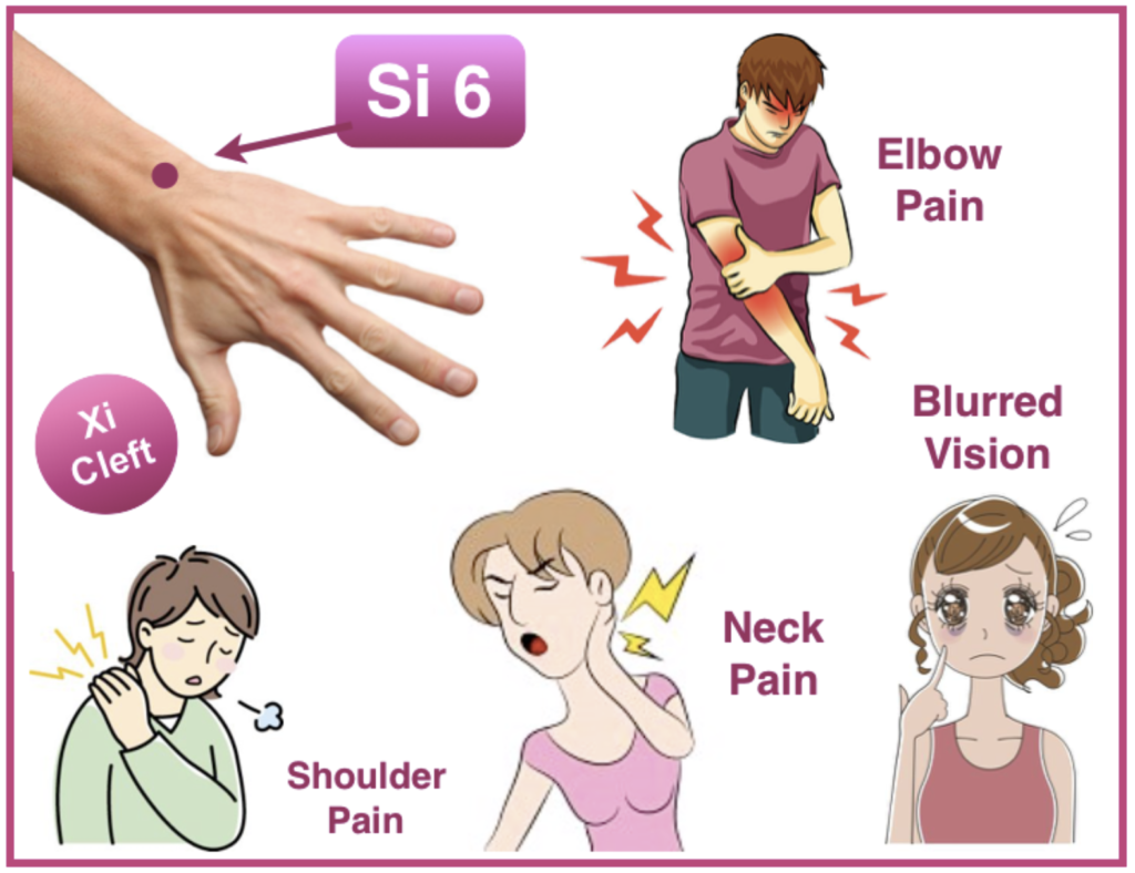 SI 6 xi cleft acupuncture point for shoulder and neck tension